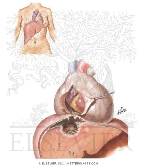 Amebic Pericarditis