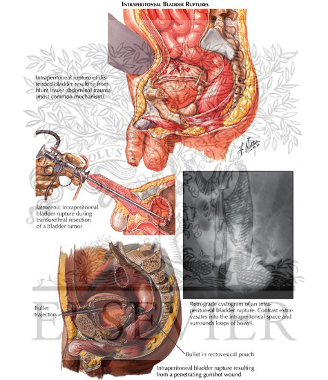 Bladder Injuries: Intraperitoneal Bladder Ruptures