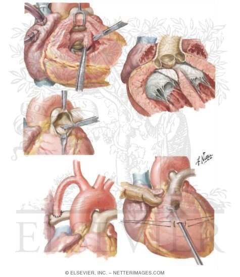 Anomalies of the Right Ventricular - Outflow Tract
Corrective Operation for Tetralogy of Fallot