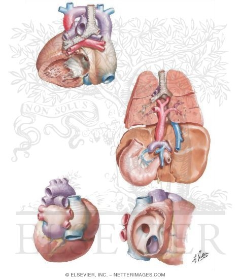 Anomalous Pulmonary Venous Connection