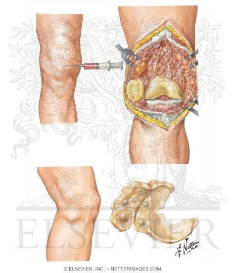 Pigmented Villonodular Synovitis - Meniscal Cysts