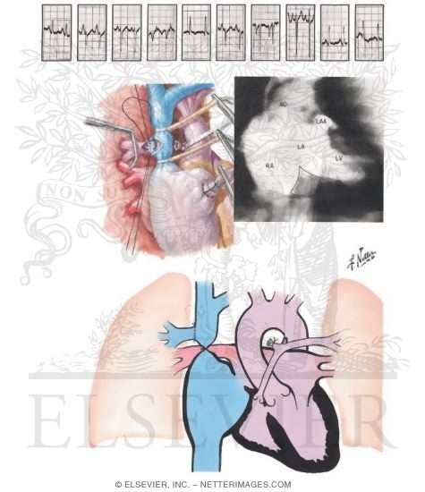Anomalies of the Tricuspid Valve