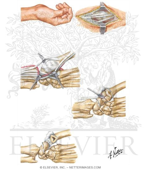 Trapezium Implant Resection Arthroplasty for Thumb Disabilities