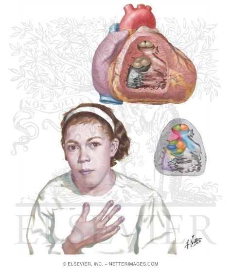 Anomalies of the Right Ventricular - Outflow Tract - Tetralogy of Fallot