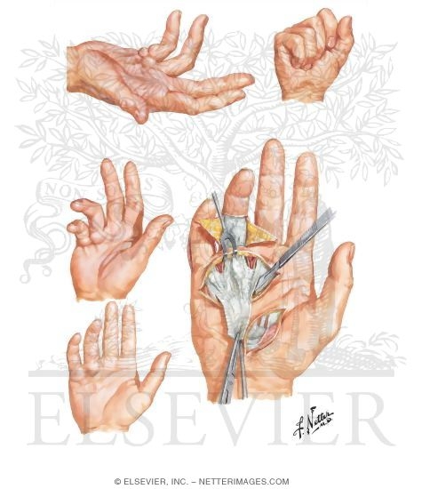 Dupuytren's Contracture