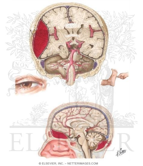 Epidural Hemorrhage