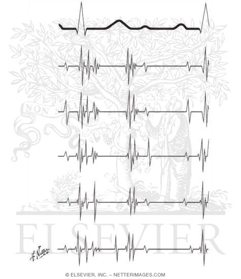 Phonocardiography