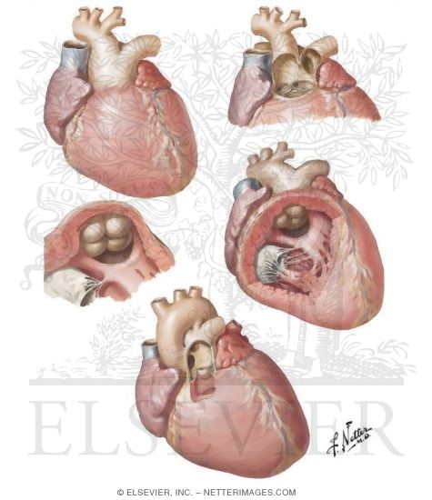 Anomalies of the Truncus Septum - Persistent Truncus Arteriosus