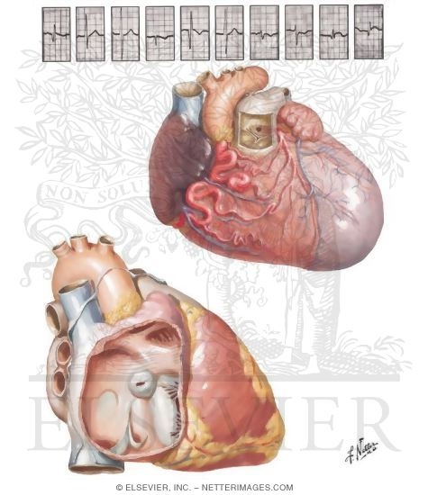 Anomalous Left Coronary Artery and Aneurysm of the Sinus of Valsalva
