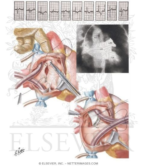 Defects of the Atrial Septum
