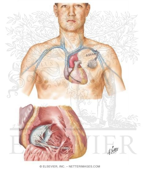 Pacemaker Implantation In Treatment of Complete Heart Block