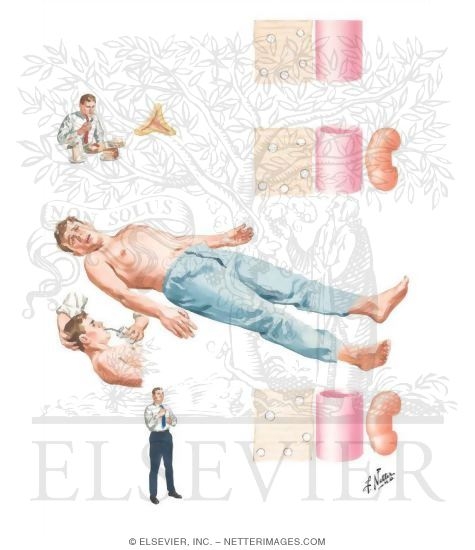 Periodic Paralysis