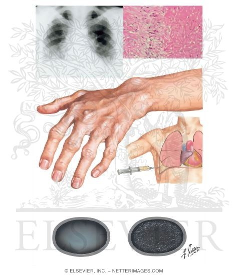 Rheumatoid Arthritis; Lung Involvement