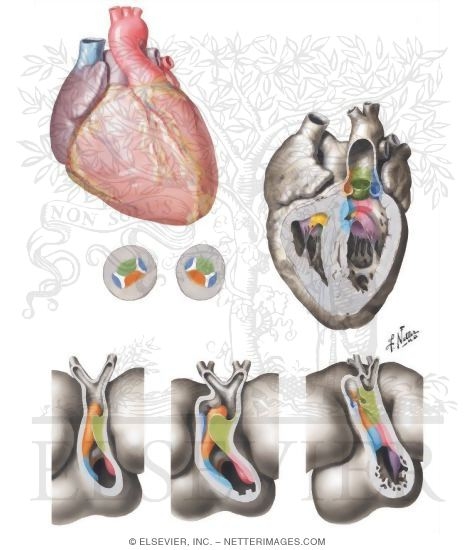 Transposition of the Great Vessels with Inversion of the Ventricles (Corrected Transposition of the Great Vessels)