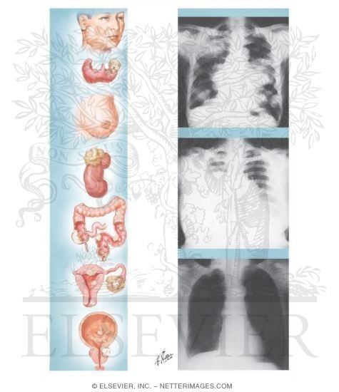 Metastatic Carcinoma to Lung