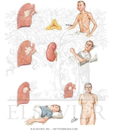 Endocrine Manifestations of Bronchogenic Carcinoma