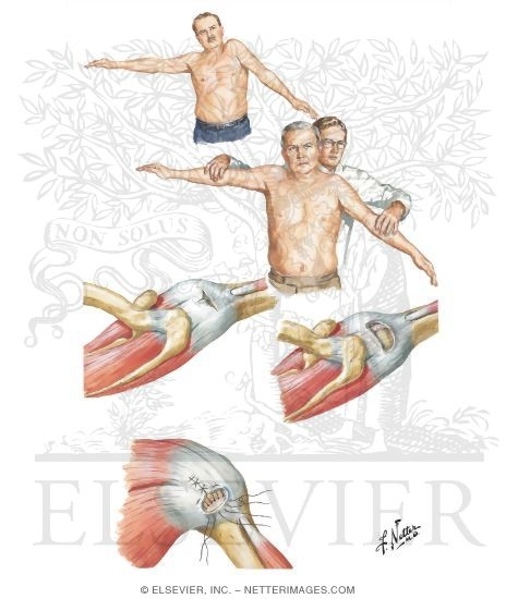 Tears and Ruptures of Rotator Cuff