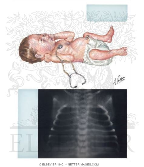 Clinical Manifestations of Hyaline Membrane Disease