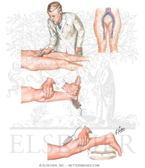 Ultrasound in Diagnosis of Acute Venous Thrombosis