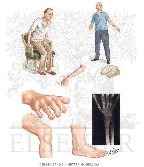Neuromuscular Manifestations of Bronchogenic Carcinoma - Connective Tissue Manifestations of Bronchogenic Carcinoma