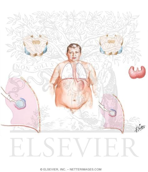 Pulmonary Edema Hyperventilation - Obesity Hypoventilation (Pickwickian syndrome) - Myxedema Hypoventilation