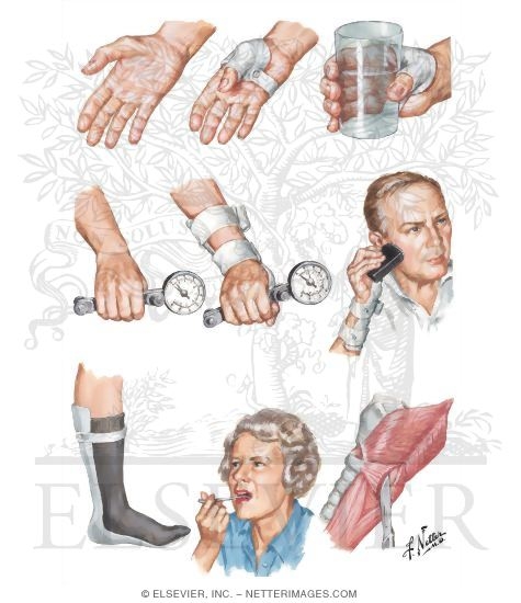 Motor neuron disease symptoms initial