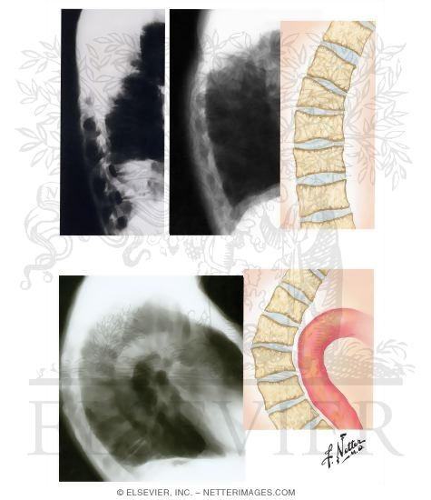 Clinical Manifestations of Osteoporotic Vertebral Compression Fractures