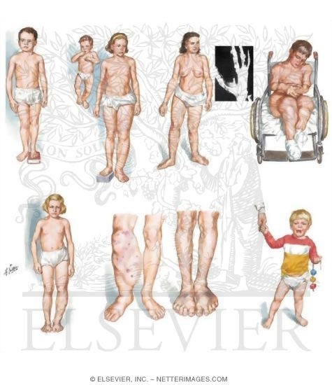 Limb Length