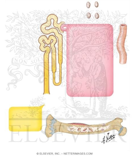 Hypophosphatemic Rickets