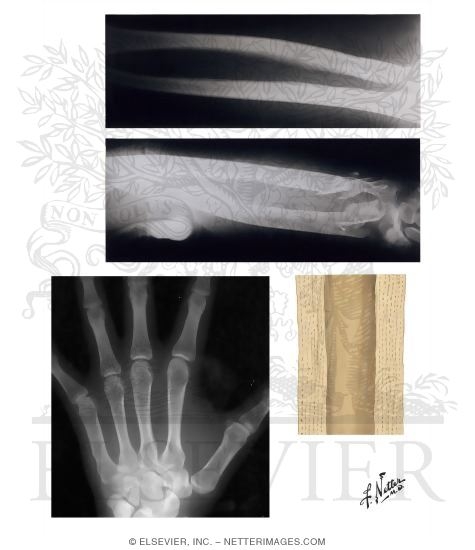 Radiographic Findings in Appendicular Osteoporosis