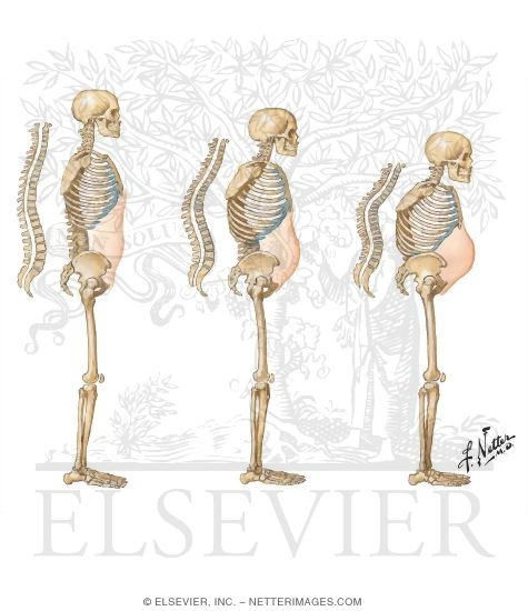 Progressive Spinal Deformity in Osteoporosis