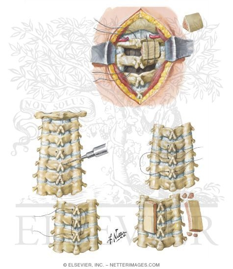 Cervical Spine Injury: Posterior Fusion