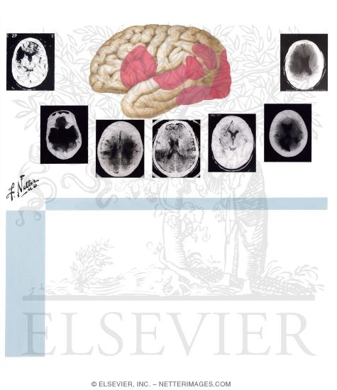 Dominant Hemisphere Language Dysfunction