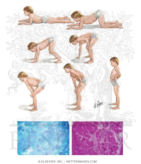 Duchenne's Muscular Dystrophy