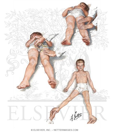 Physical Examination In Legg - Calve - Perthes Disease