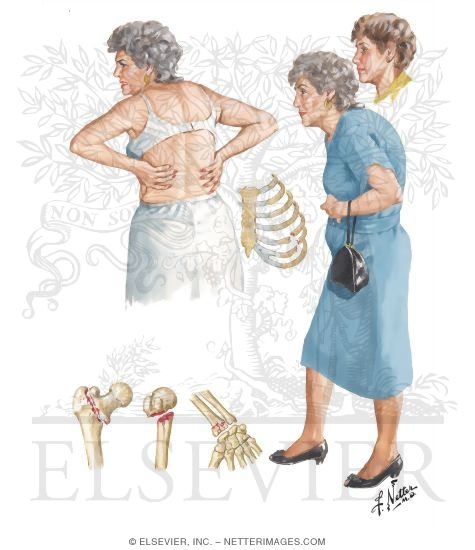 Osteoporosis in Postmenopausal Women