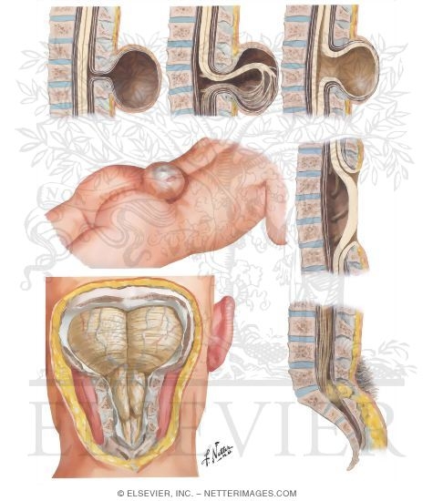 Spina Bifida Images