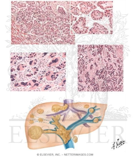 Tumors III - Histology and Spread of Primary Carcinoma