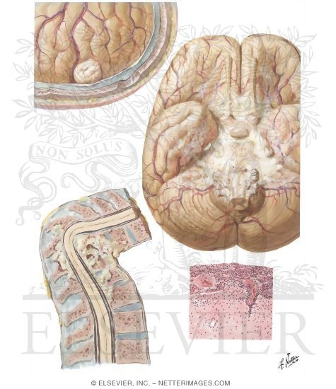 Tuberculosis of the Brain and Spine