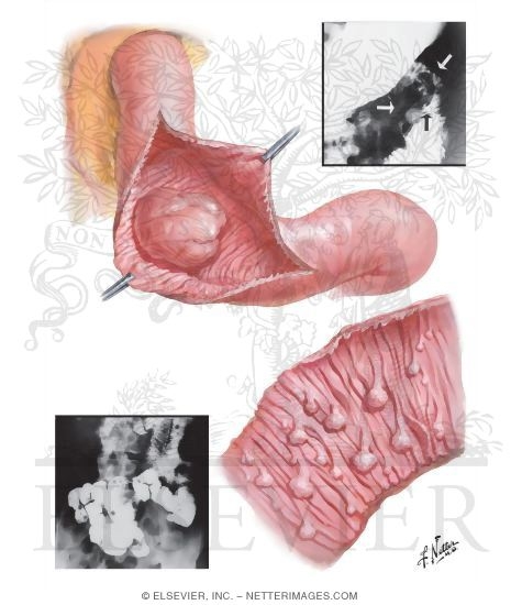 Benign Tumors of Small Intestine and Peutz-Jeghers Syndrome