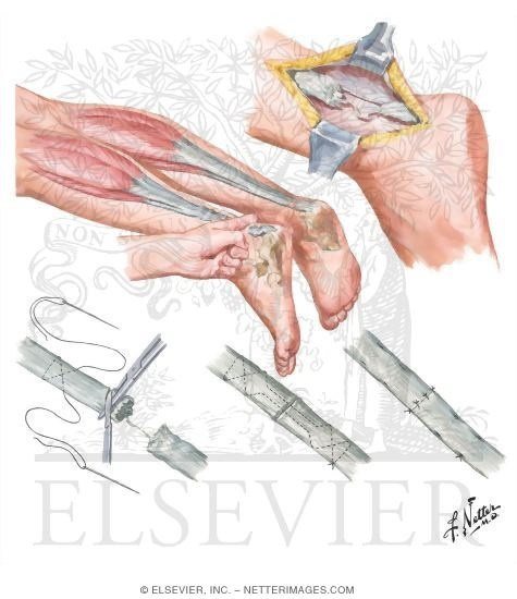 Rupture of Achilles Tendon