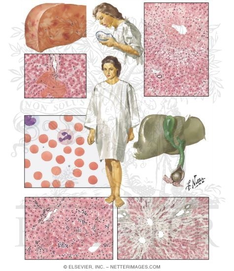 Liver Disease in Pregnancy