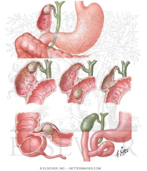 Bile Duct Fistulae