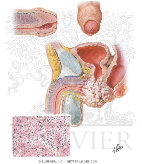 Papilloma, Cancer of Urethra