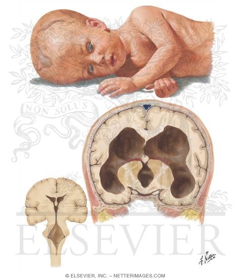 Images Of Hydrocephalus