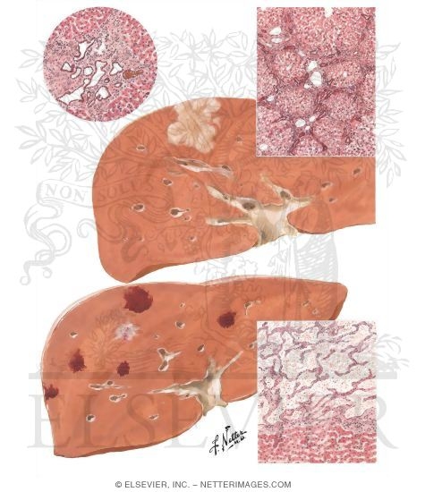 Tumors I - Hamartomas, Hemangiomas