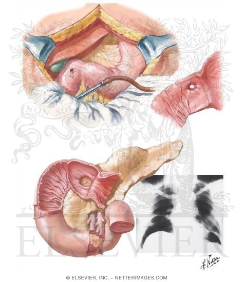 Peptic Ulcer VIII - Complications of Gastric and Duodenal Ulcers