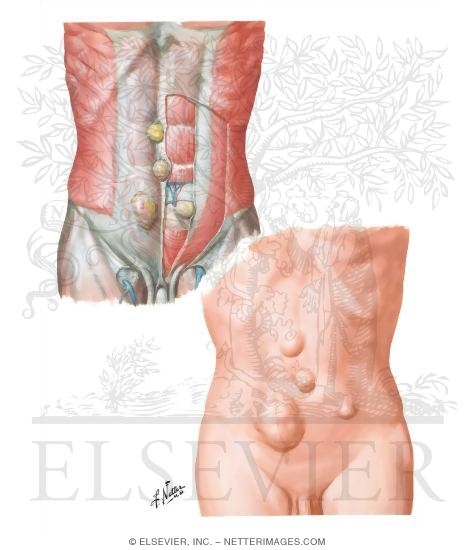 Hernia IV - Ventral Hernia