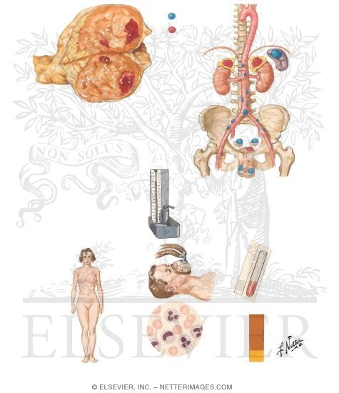 Chromaffin Tumors of the Adrenal Medulla