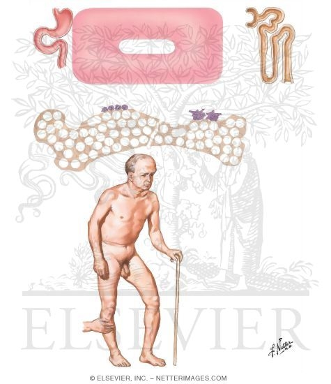 Osteitis Deformans